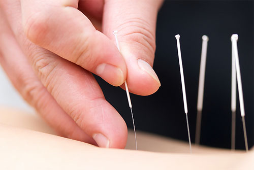 Treating Patient with Acupuncture